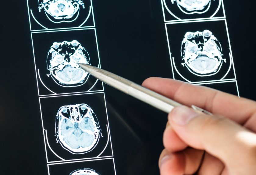Impact of Traumatic Brain Injury
